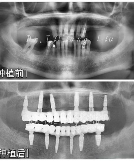 全冠移植是什么意思？一篇讲透园林绿化中的关键技术