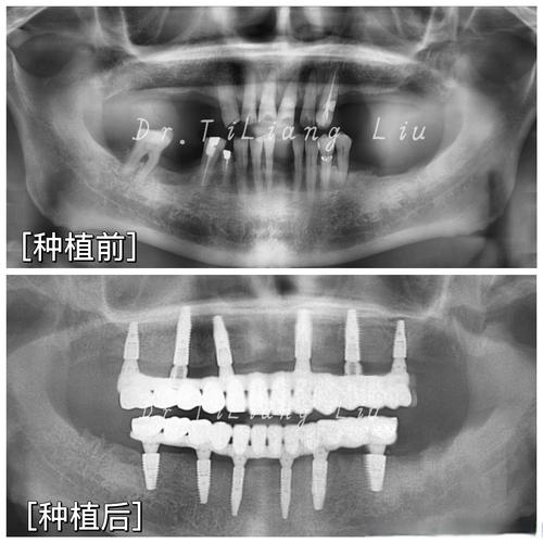 全冠移植是什么意思?一篇讲透园林绿化中的关键技术 全冠移植是什么意思?一篇讲透园林绿化中的关键技术