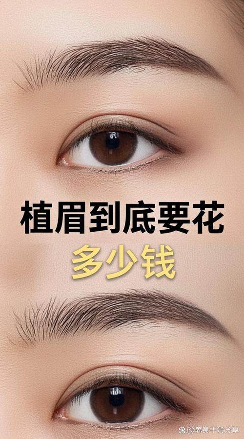 毛发移植一般需要多少钱? 规格:移植毛囊单位数量是核心定价因子