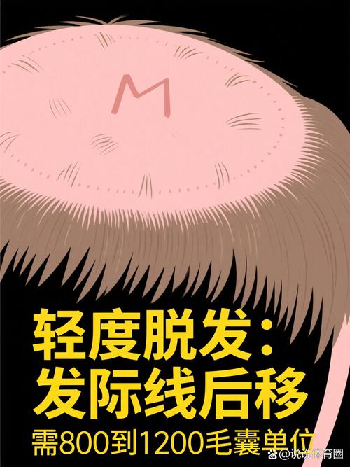 毛发种植大概多少费用?2025年市场参考区间与影响因素全解析 费用综合参考表格