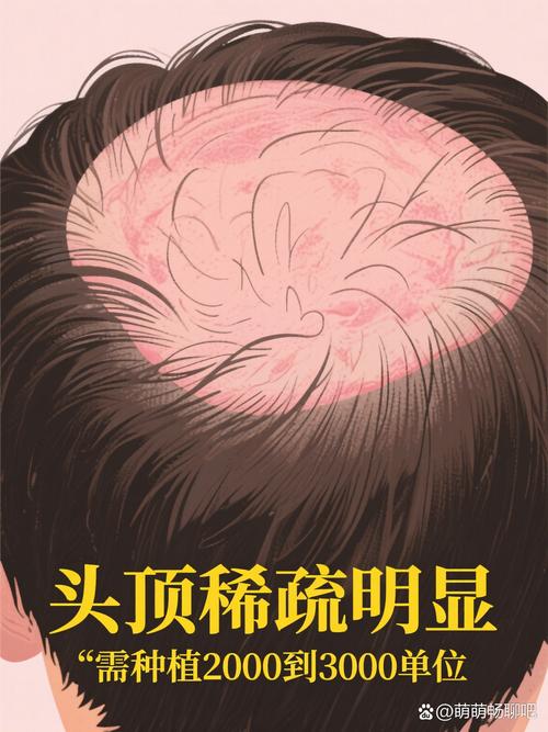 毛发种植大概多少费用?2025年市场参考区间与影响因素全解析 咨询指南:如何获取专属报价?