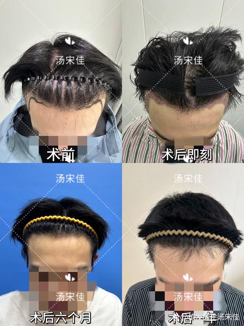 毛发种植价格 数量因素:移植总量与套餐优惠