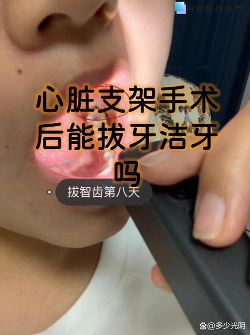 有心脏支架能种牙吗?答案不是简单的“能”或“不能” 三、哪些情况不建议马上种牙?
