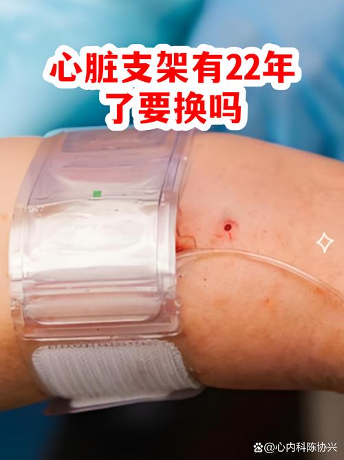 有心脏支架能种牙吗?答案不是简单的“能”或“不能” 五、种牙时最重要的问题:药能不能停?