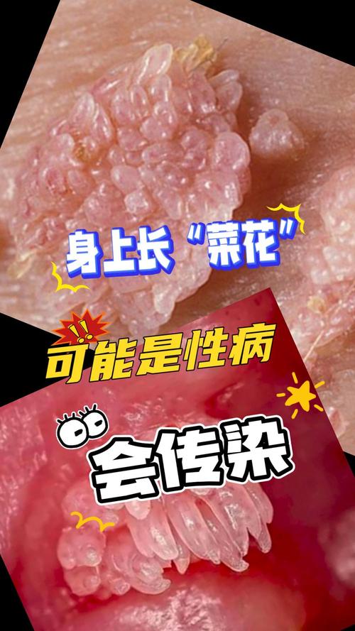 园艺植物“菜花状”病变:是恶性病害还是良性现象? 一、两种常见的“菜花状”病变