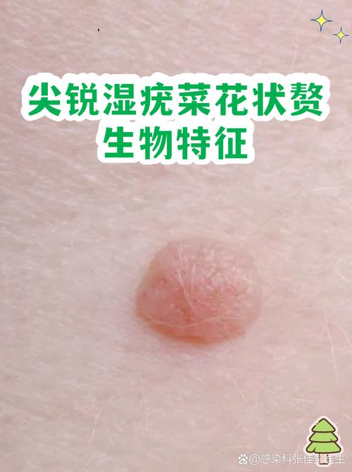 园艺植物“菜花状”病变:是恶性病害还是良性现象? 四、特殊情况:真菌性“菜花状”