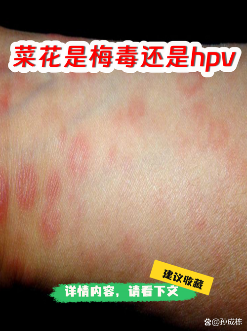 园艺植物“菜花状”病变:是恶性病害还是良性现象? 总结